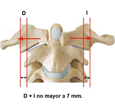 fractura vertebral