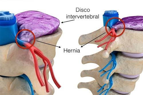 Cirugía de Hernia de disco